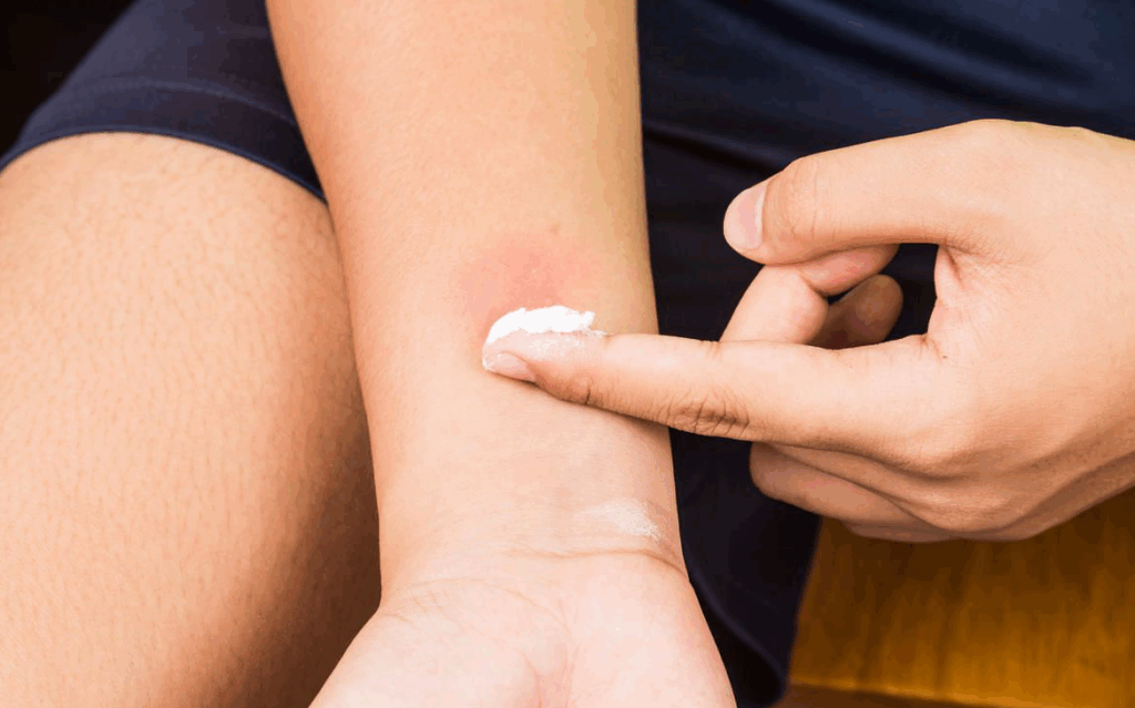 чем лечить укусы блох